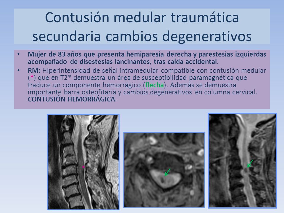 contusion medular